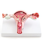 Uterus-Modell mit Erkrankungen von HeineScientific