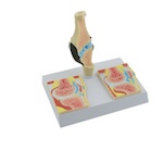 Knee Model with Rheumatism